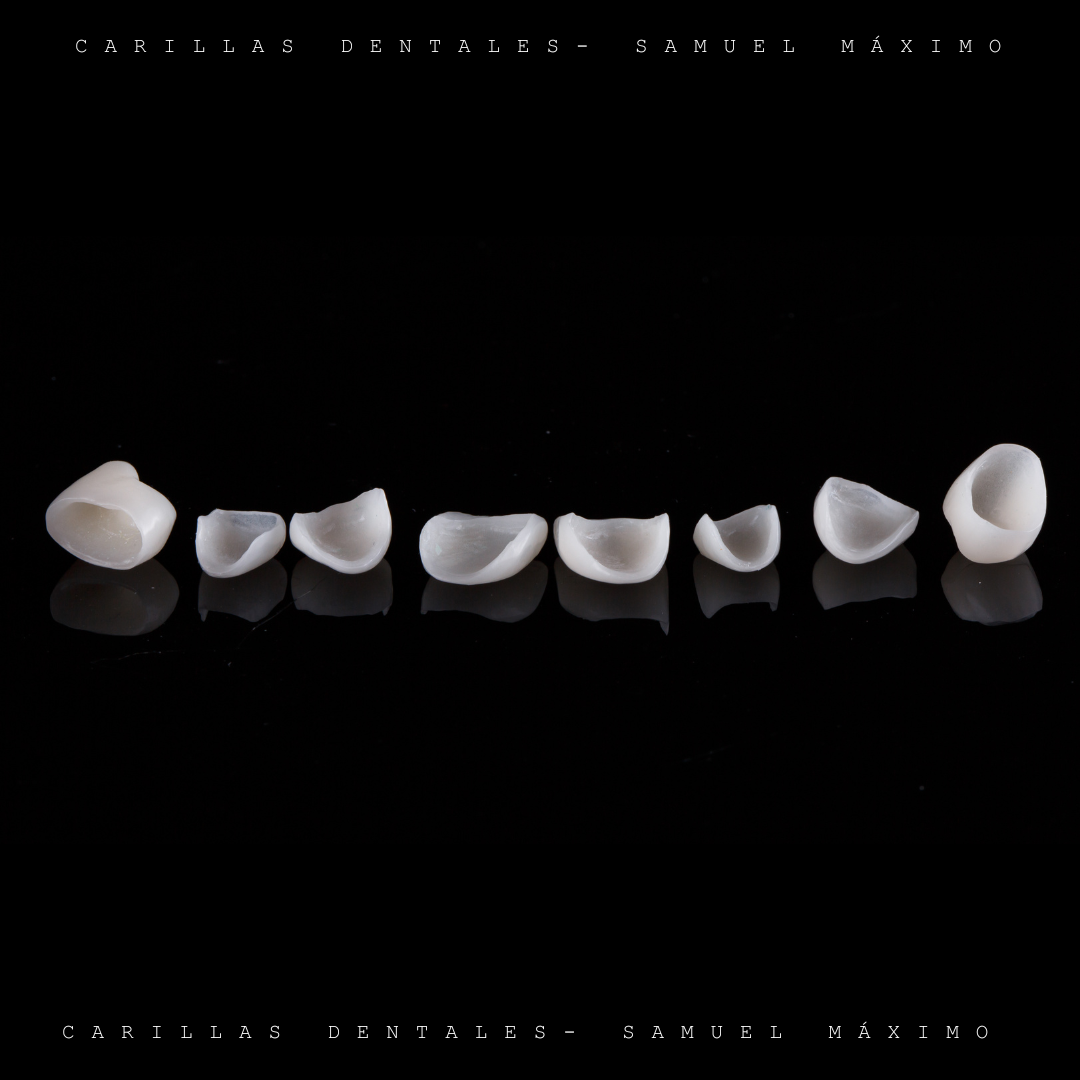 Carillas de Porcelana