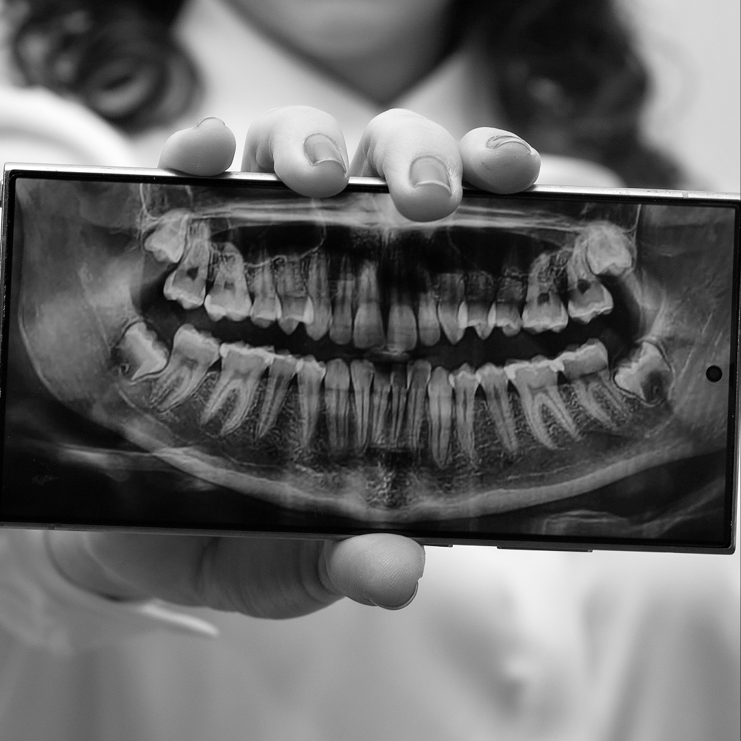 Extracción de Muelas del Juicio