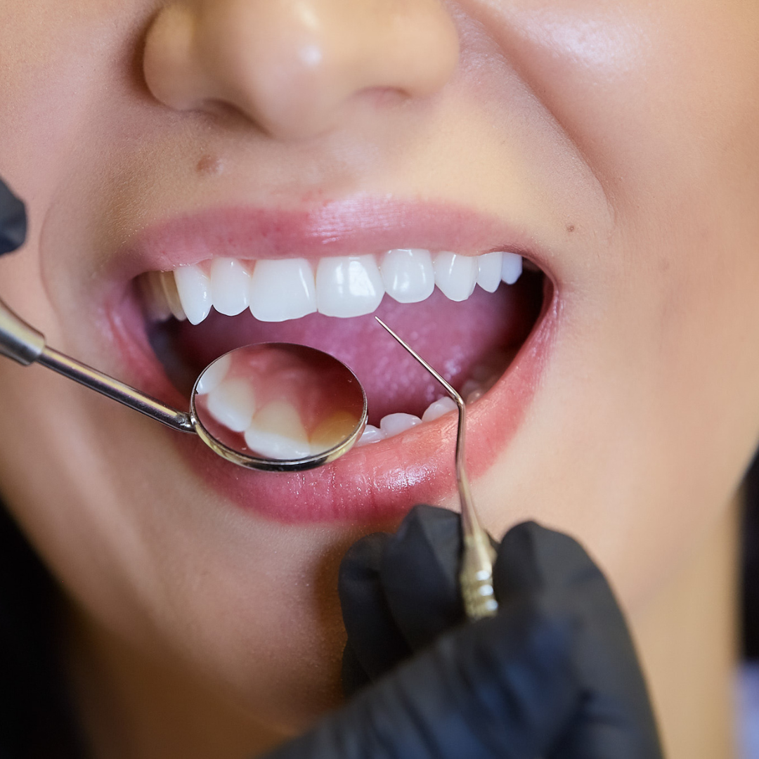 Limpieza Dental Profunda