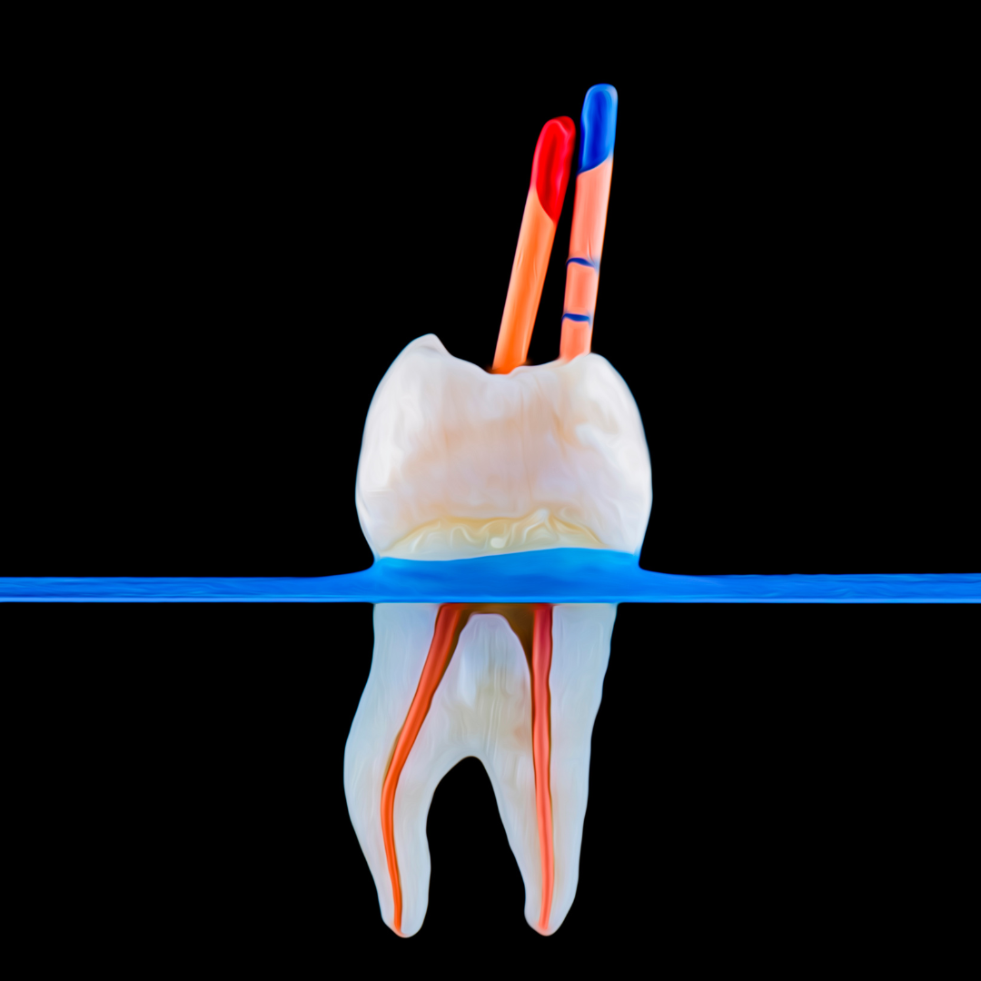 Tratamiento de Conducto Radicular