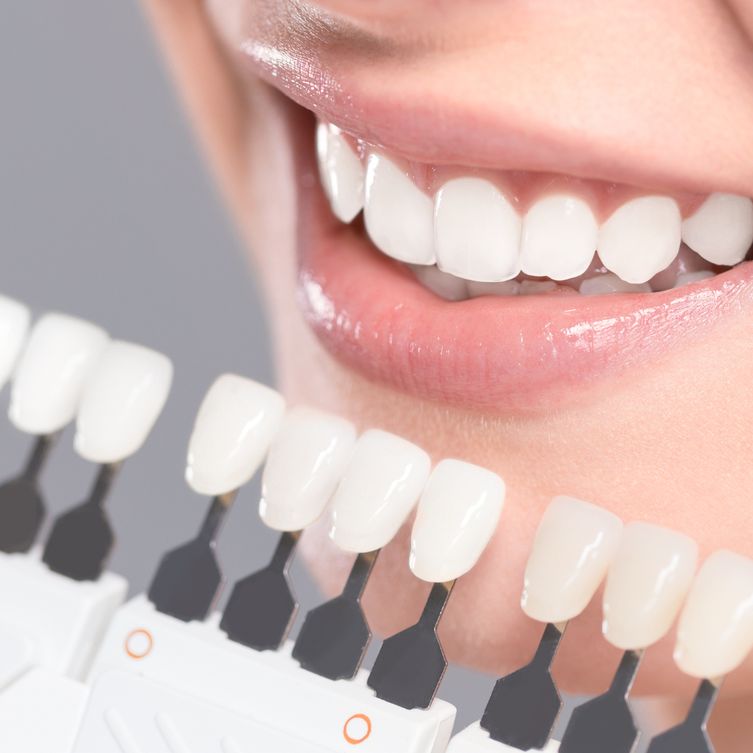 Blanqueamiento Dental